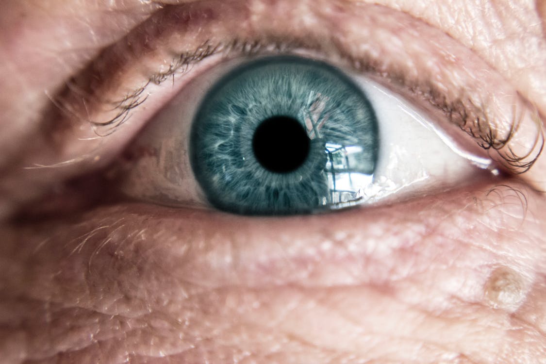 Eye of Person with Low Vision From Albinism
