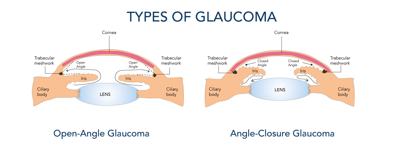 glaucoma type